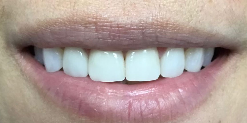 Smile Gallery